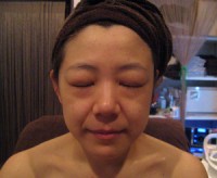 施術前です