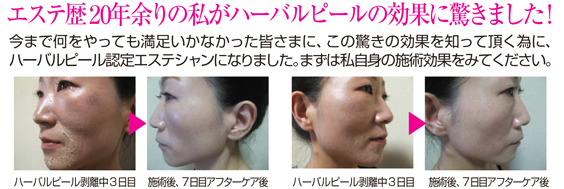 エステ歴20年余りの私がハーバルピールの効果に驚きました! 今まで何をやっても満足いかなかった皆さまに、この驚きの効果を知って頂く為に、ハーバルピール認定エステシャンになりました。まずは私自身の施術効果をみてください。